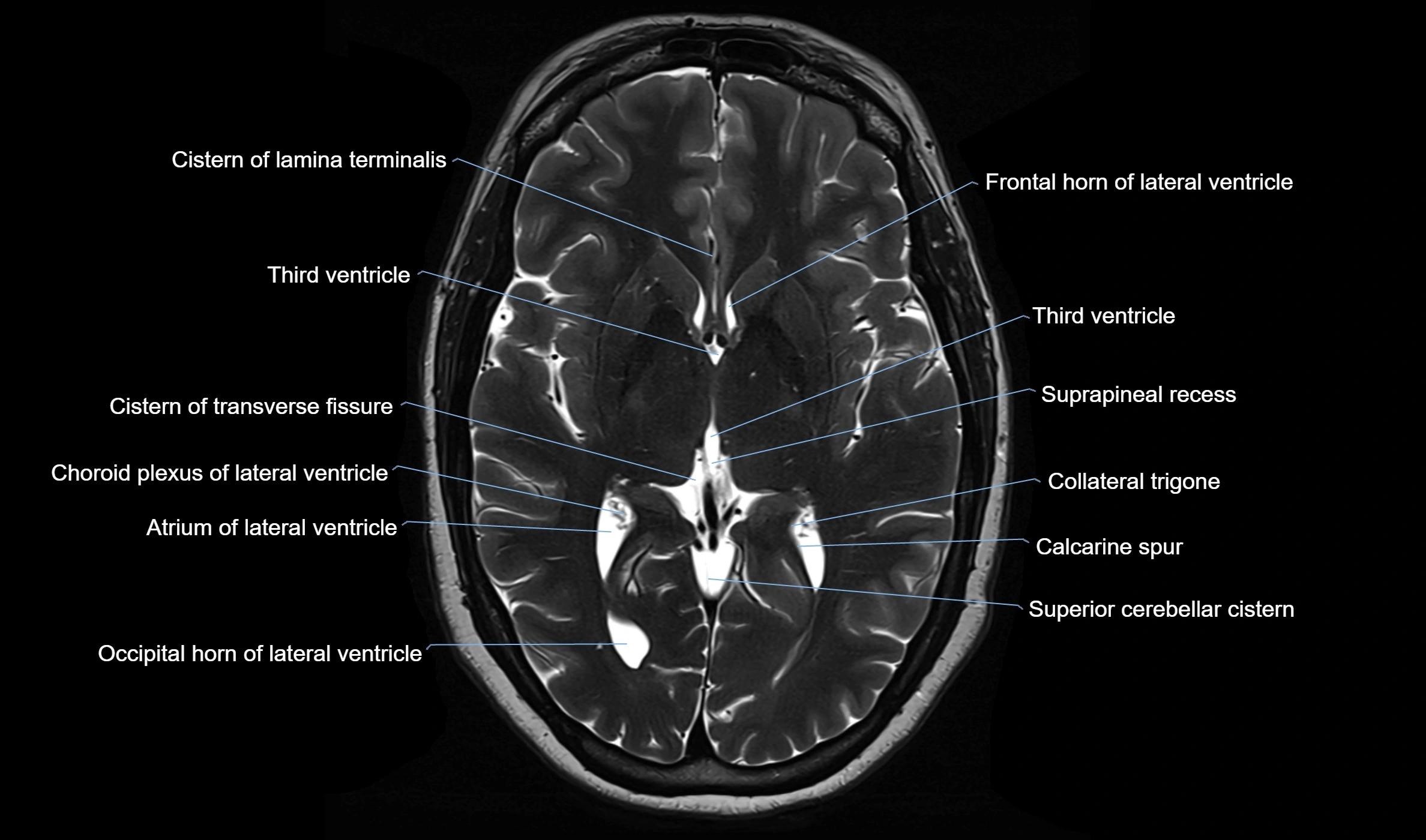 Brain cisterns  and ventricles  axial anatomy 3T MRI image-img-00001-00028.webp